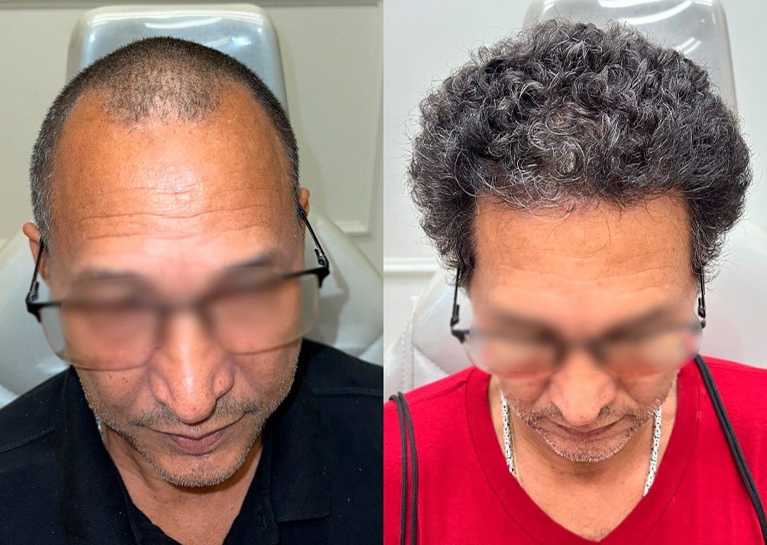 Resultado antes e depois