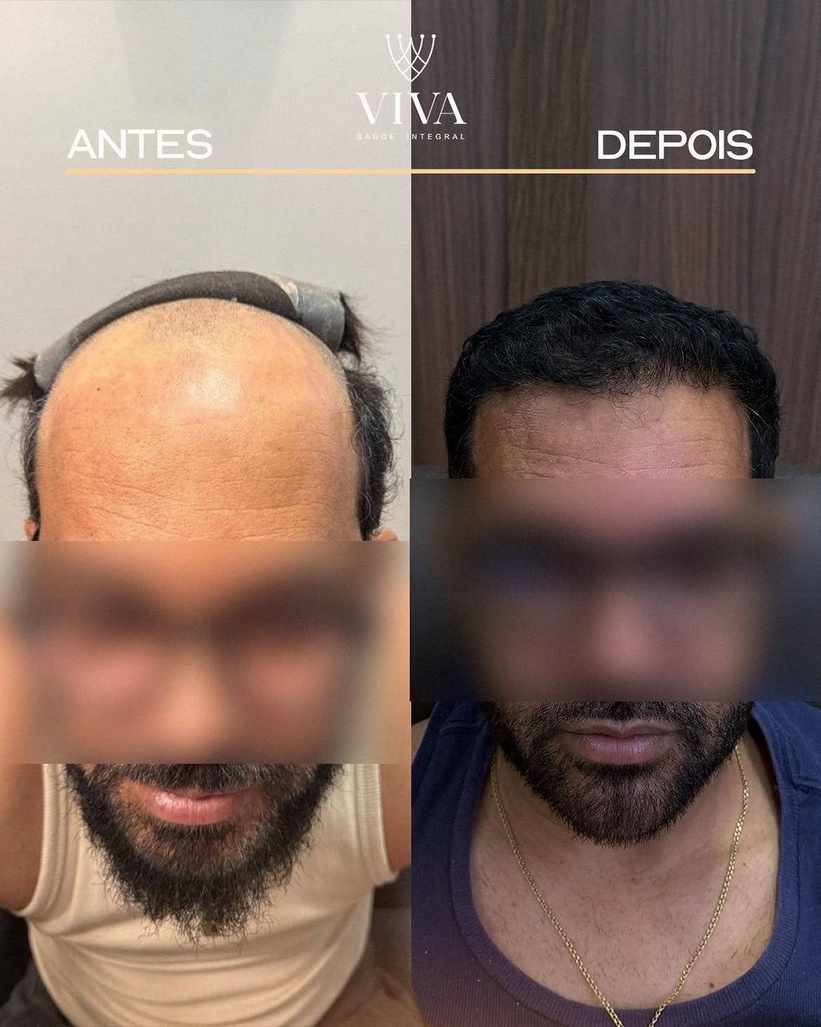 Resultado antes e depois