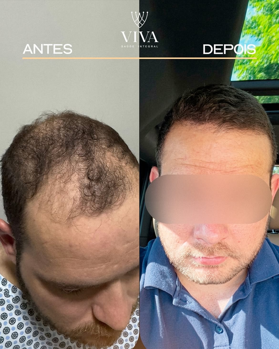 Resultado antes e depois