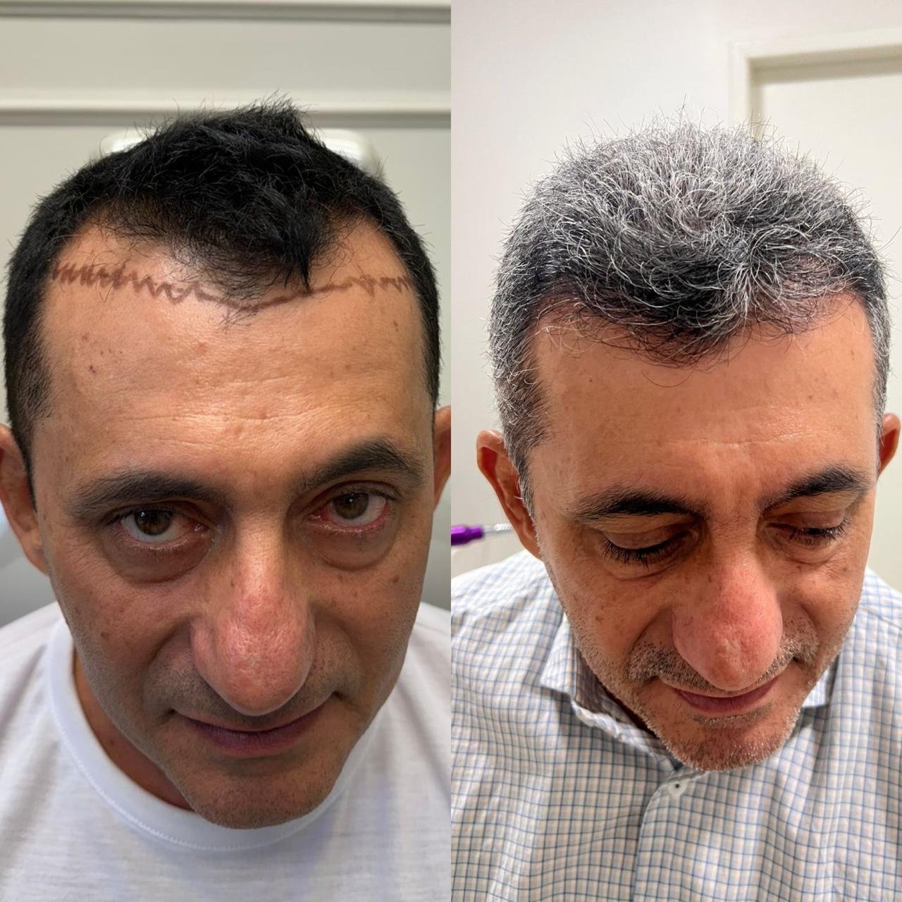 Resultado antes e depois
