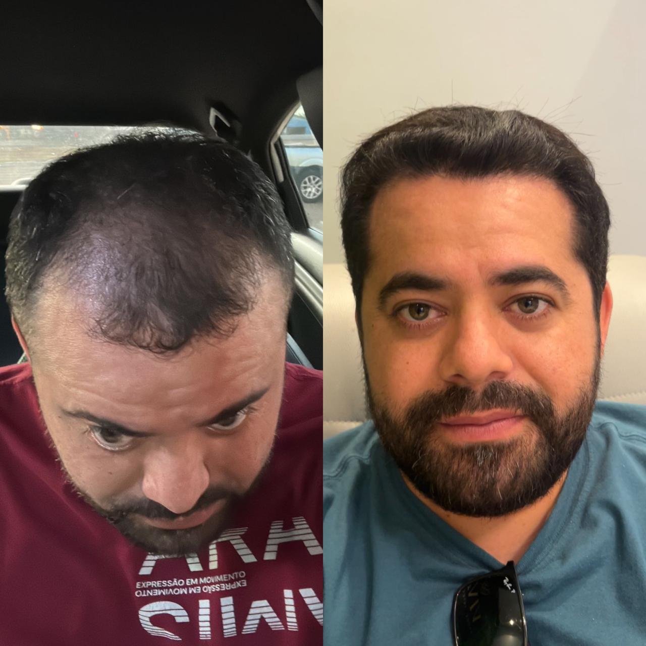 Resultado antes e depois
