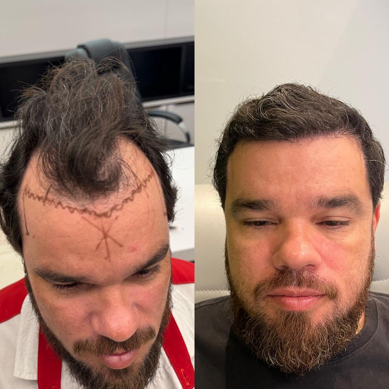 Resultado antes e depois